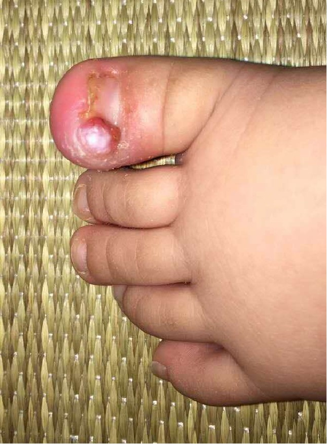 第一疗程 结痂形成