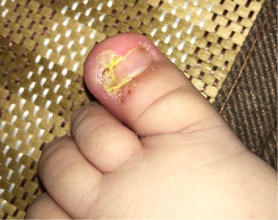 第二疗程 药粉外敷去腐